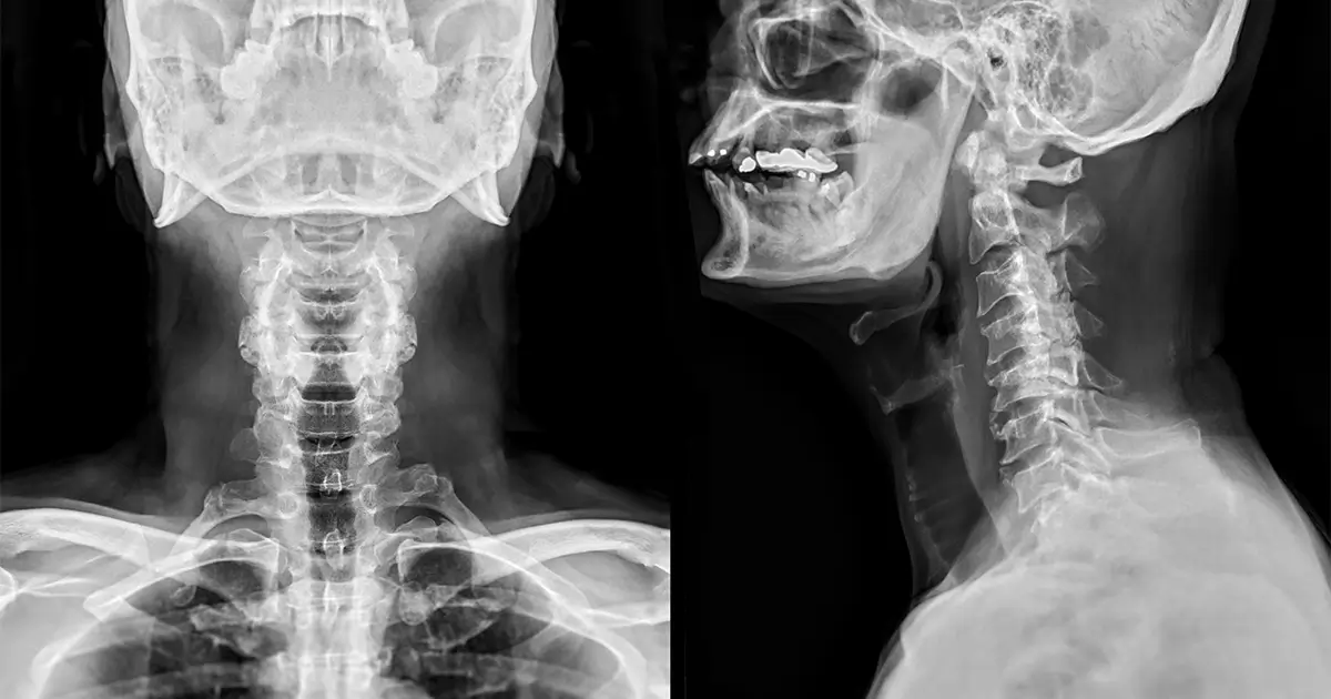 Spine X-ray